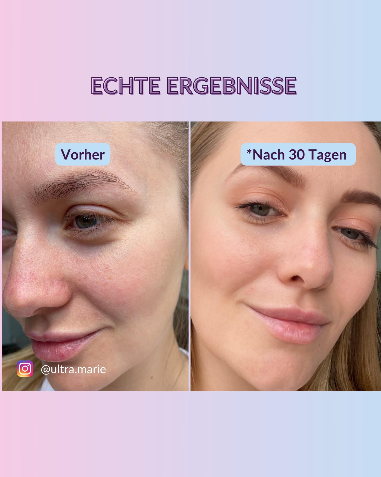 Crema de ácido hialurónico